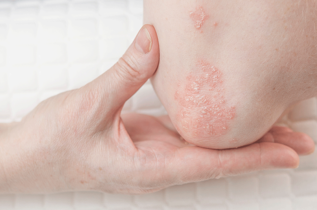Elbows showing pronounced red, flaky and silvery‑scaled skin plaques on the outer joint surfaces, illustrating a common skin manifestation associated with psoriatic arthritis.