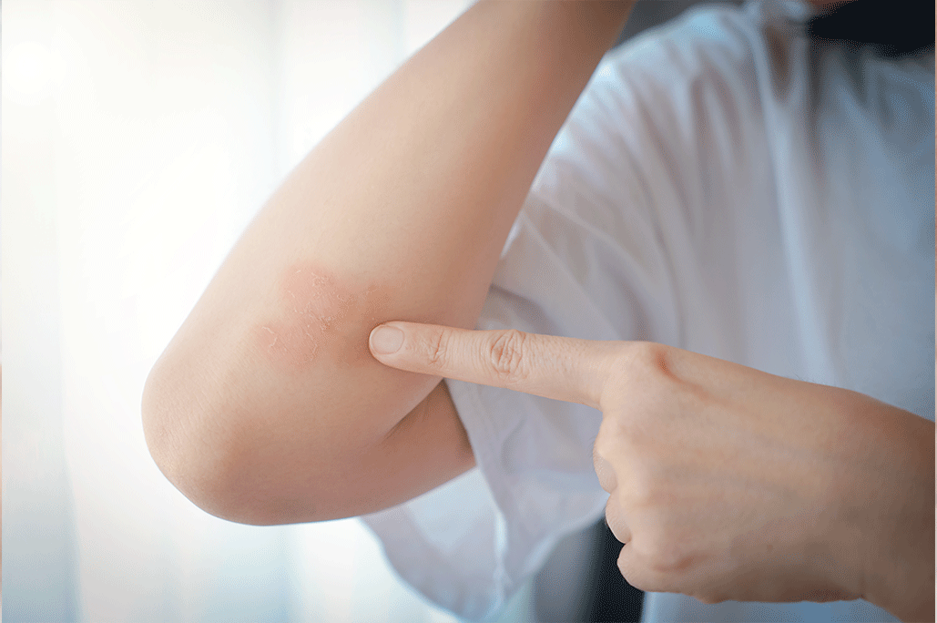 Asian woman’s forearm affected by acute plaque psoriasis, with raised red patches and silvery‑white scales on the skin.