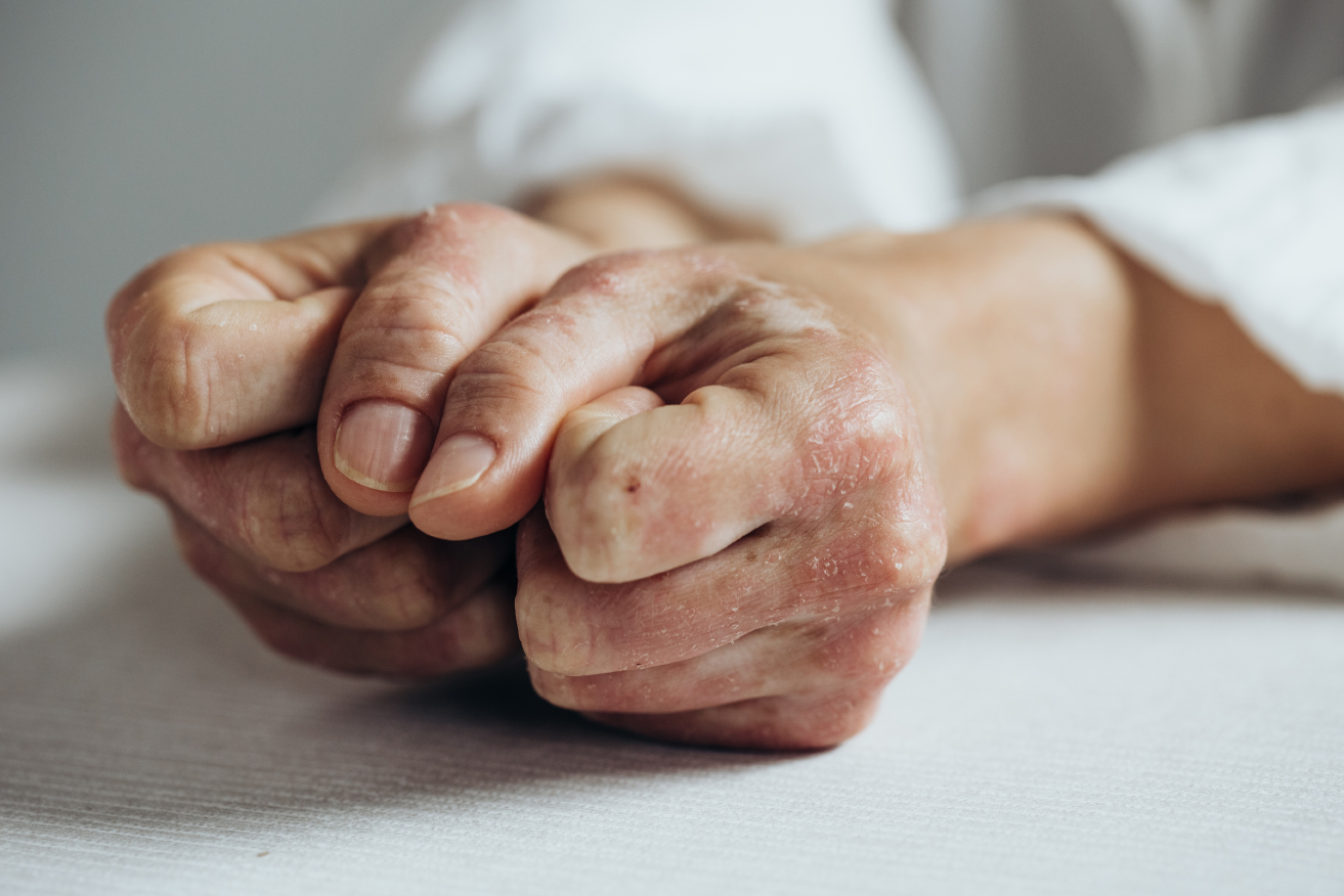 Close-up of hands inflicted with psoriatic arthritis